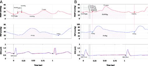 Pulmonary artery wedge pressure measurements. The top panel shows the... | Download Scientific ...