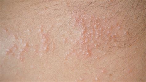 11 NATURAL WAYS TO GET RID OF HEAT RASHES - Health GadgetsNG
