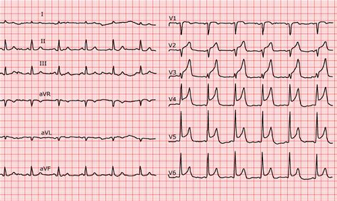 [Cardio-FR] STEMI (ST Elevation Myocardial Infarction) in the ...