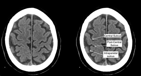 Radiological Anatomy: Central Sulcus - Stepwards