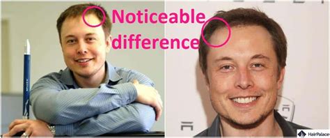 Elon Musk Hair Transplant | The Secret of His Amazing Result