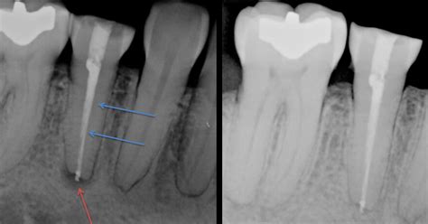 Root Canal Infection Xray