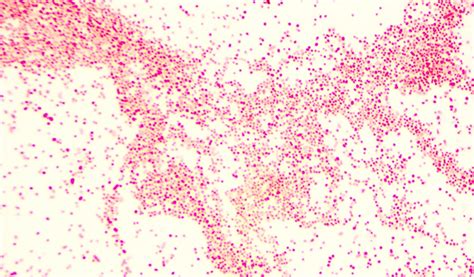 Pasteurella Multocida Human Infection