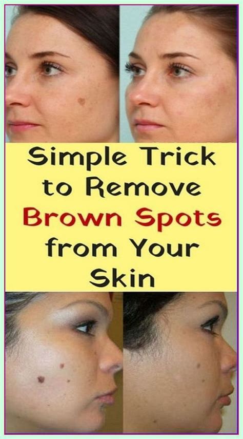 Simple trick to remove brown spots from your skin – Artofit