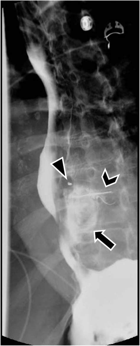 Image obtained during fluoroscopic esophagram demonstrating a large ...