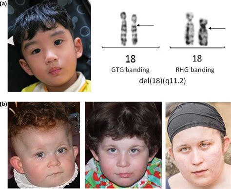 18q deletion syndrome, causes, symptoms, diagnosis, treatment & life ...