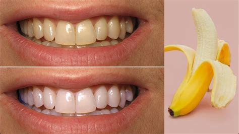 Magical Teeth Whitening Remedy | Get whiten Teeth With Banana Paste ...