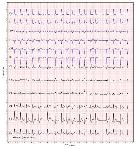 Atrial fibrillation: ECG, classification, causes, risk factors & management – ECG & ECHO