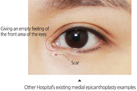 Charming Medial Epicanthoplasty – GRACEONYOUNG PLASTIC SURGERY