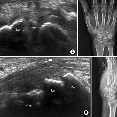 Wrist ultrasound images of the patient (A, B) and a normal subject (C,... | Download Scientific ...