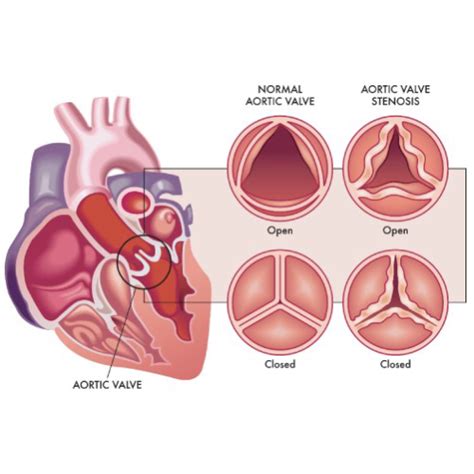 Treatment of Aortic Stenosis - TAVR, TAVI, SAVR | Dr Raghu