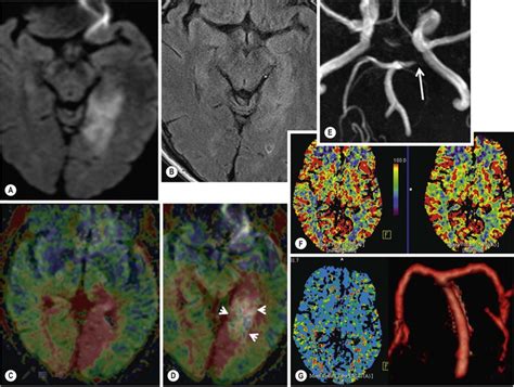 Neurovascular Diseases | Radiology Key