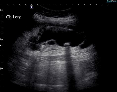 Adenomyomatosis Gallbladder