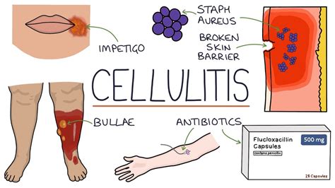 Understanding Cellulitis: Skin and Soft Tissue Infections - YouTube