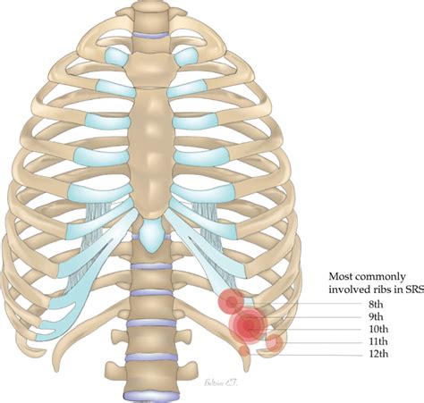 The most commonly involved ribs in slipping rib syndrome. Image ...