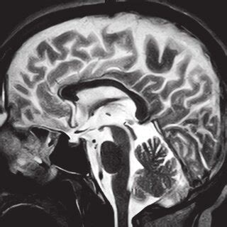 T1 weighted MRI showing normal cerebellum. | Download Scientific Diagram