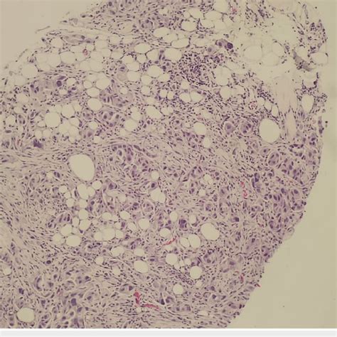 Patient #1: Tru-cut biopsy of the supraclavicular lymph node. Tumor... | Download Scientific Diagram