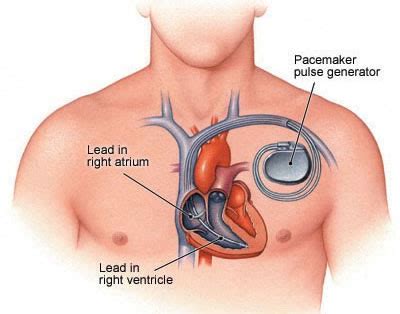 Artificial Cardiac Pacemaker Implantation | H2H Cardiac Center