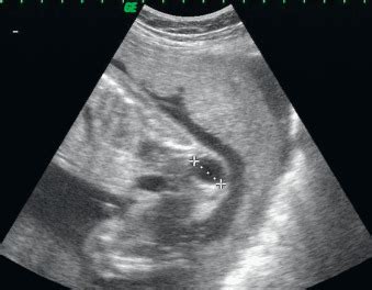 Sacrococcygeal Teratoma and Fetus in Fetu | Radiology Key