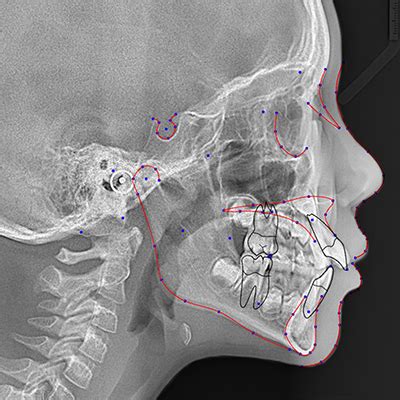 Automatic Cephalometric Analysis & Teeth Segmentation Service | Cephx