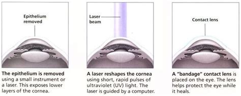 PRK – Wilmington, Delaware – Photorefractive Keratectomy