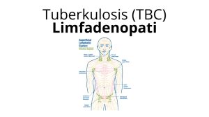 Tuberkulosis (TBC) Limfadenopati | Yayasan KNCV Indonesia