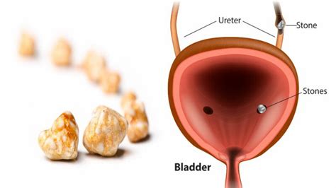 7 Things That Cause Bladder Stones (And How to Prevent Them)