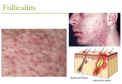 Folliculitis : Causes, Symptoms And Treatment