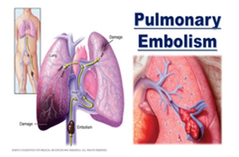 Pulmonay Embolism (Blood Clot In The Lung)