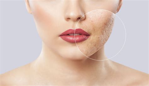 Achieve Clear Skin: #1 Atrophic Acne Scars Treatment Guide