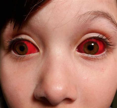 Interesting case of a child having red eyes due to subconjuctival hemorrhage : r/medizzy
