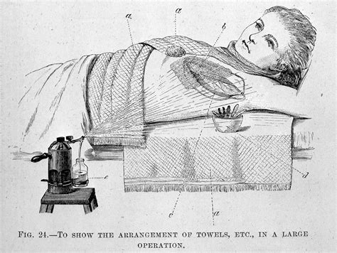 Lister spray in use from Cheyne, Antiseptic Surgery. | Wellcome Collection