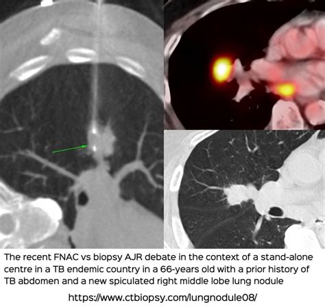 Lung Nodules - 20-50 mm - CT Guided Biopsy