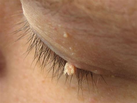 Filiform warts: What they look like, treatment, and causes