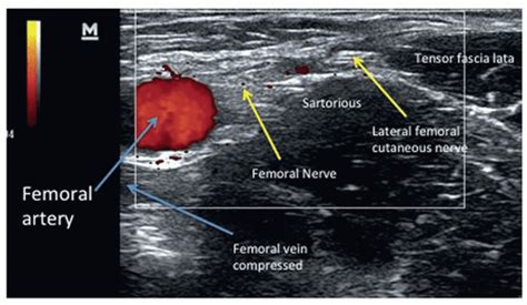 Ultrasound Guided Lateral Femoral Cutaneous Nerve Block Nysora Nysora ...