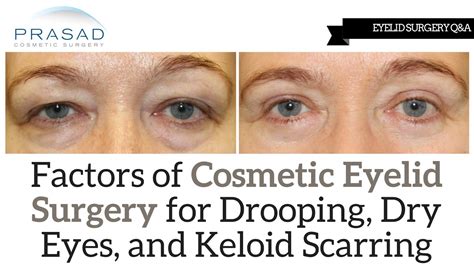 Why Factors of Eyelid Surgery Like Dry Eyes, Possible Ptosis, and Everted Eyelids Need a ...