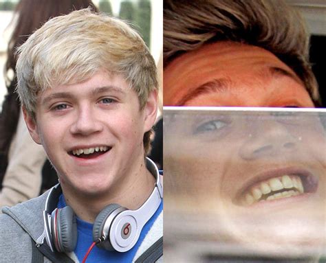 Niall Horan - Celebrity teeth - before & after - Digital Spy