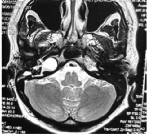 Hyperintense expansile lesion within the right petrous apex bone on MRI... | Download Scientific ...