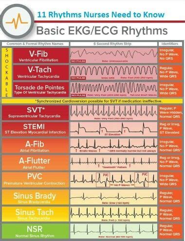 How To Read Ekg Strips For Dummies - Maryann Kirby's Reading Worksheets