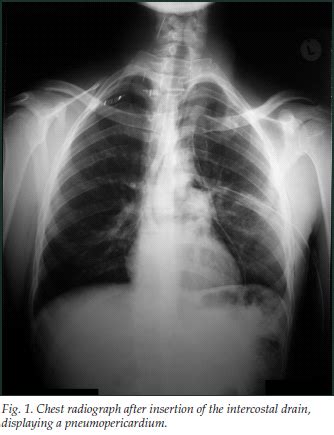 Pneumopericardium