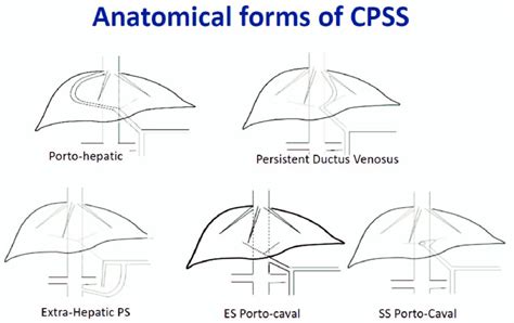 Anatomical forms of congenital portosystemic shunt (CPSS). The ...