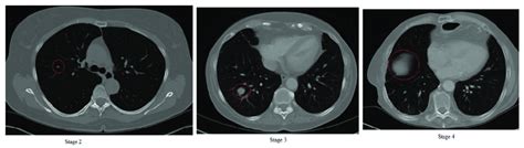 Stage 4 ling cancer | doctorvisit