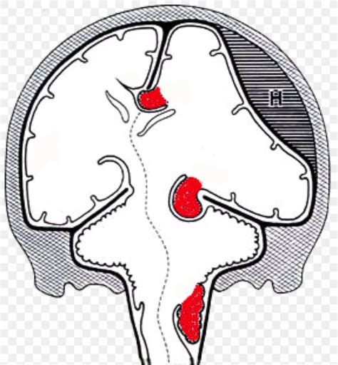 Brain Herniation Intracranial Pressure Uncus, PNG, 1039x1125px, Watercolor, Cartoon, Flower ...