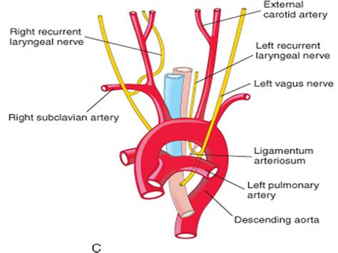 Left Recurrent Laryngeal Nerve Ligamentum Arteriosum