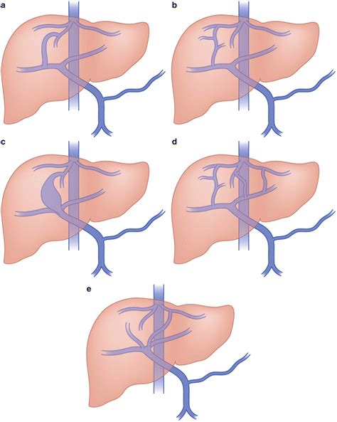 Congenital Portosystemic Shunts: Diagnosis and Percutaneous Management | Radiology Key