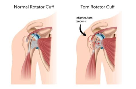 Rotator Cuff Tear | Symptoms, Repair, & Recovery Time