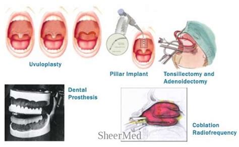 Adenoidectomy | Adenoidectomy is the surgical removal of the… | Flickr