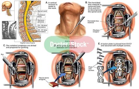 Spine Surgery - C5-6 and C6-7 Anterior Cervical Discectomy with Spinal ...