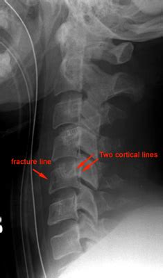 Imaging Evaluation of Cervical Spine