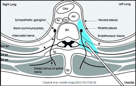 Thoracic Paravertebral Block – European Society for Paediatric ...